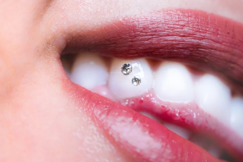 Applicazione gioiello dentale